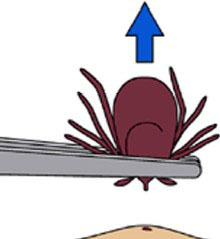 How to remove a tick