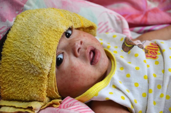Child with measles