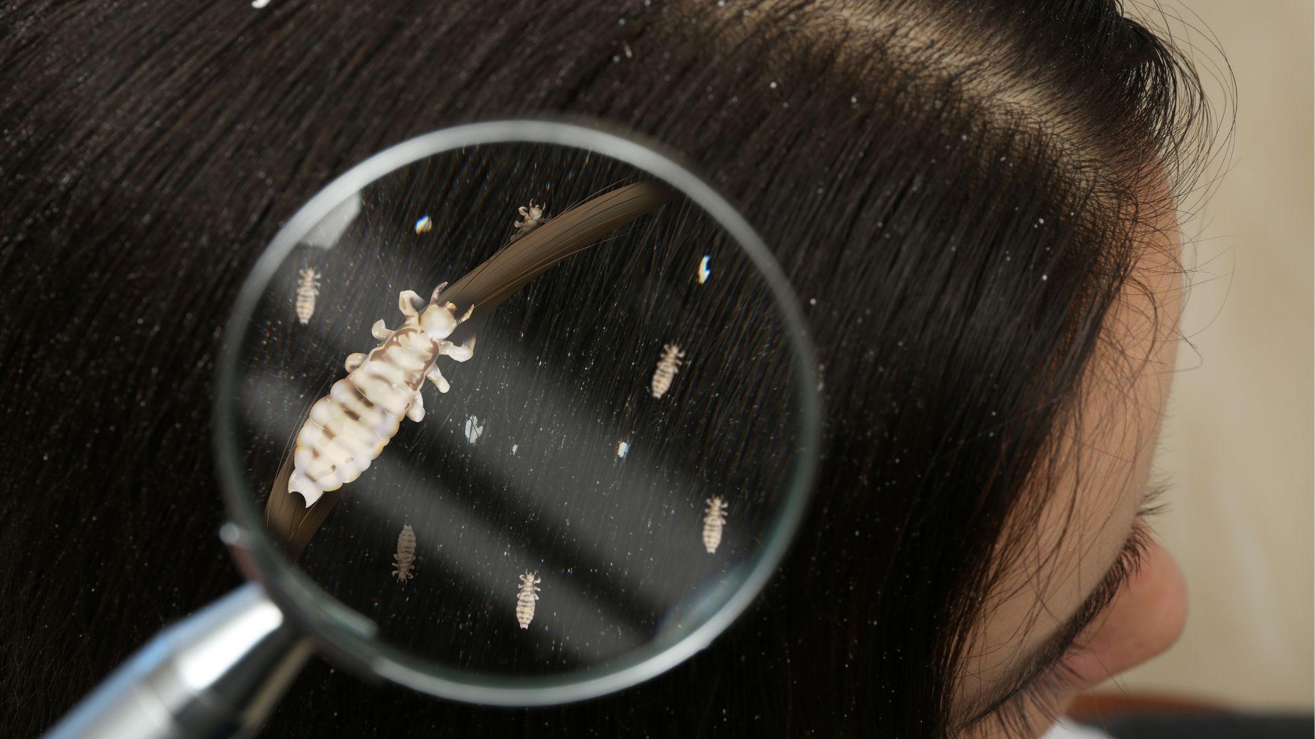 Head Lice