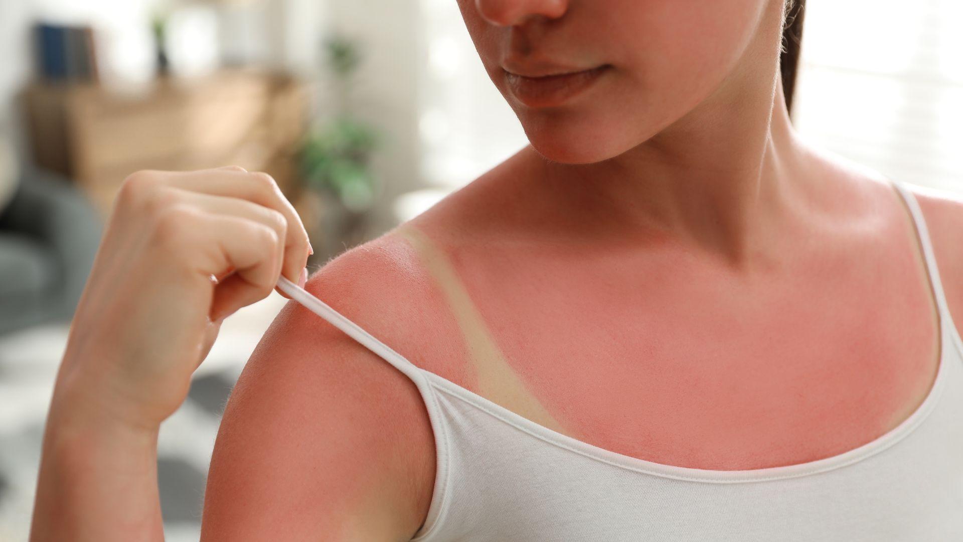 skin cancer