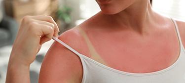 a person with sunburn
