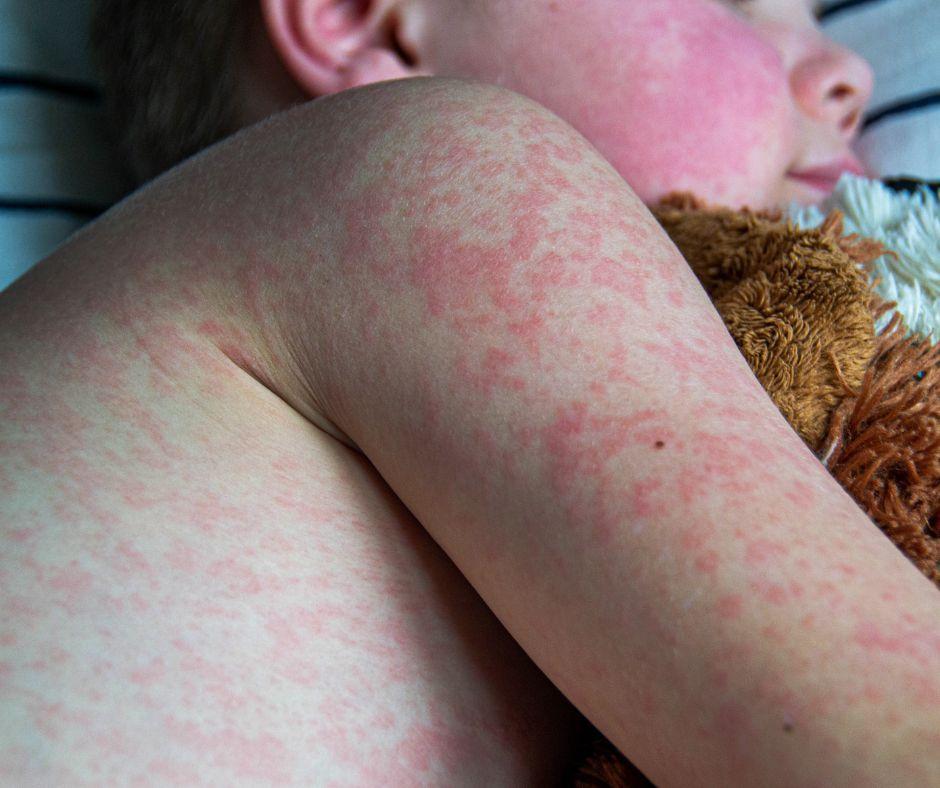A young child with the measles lying in bed 
